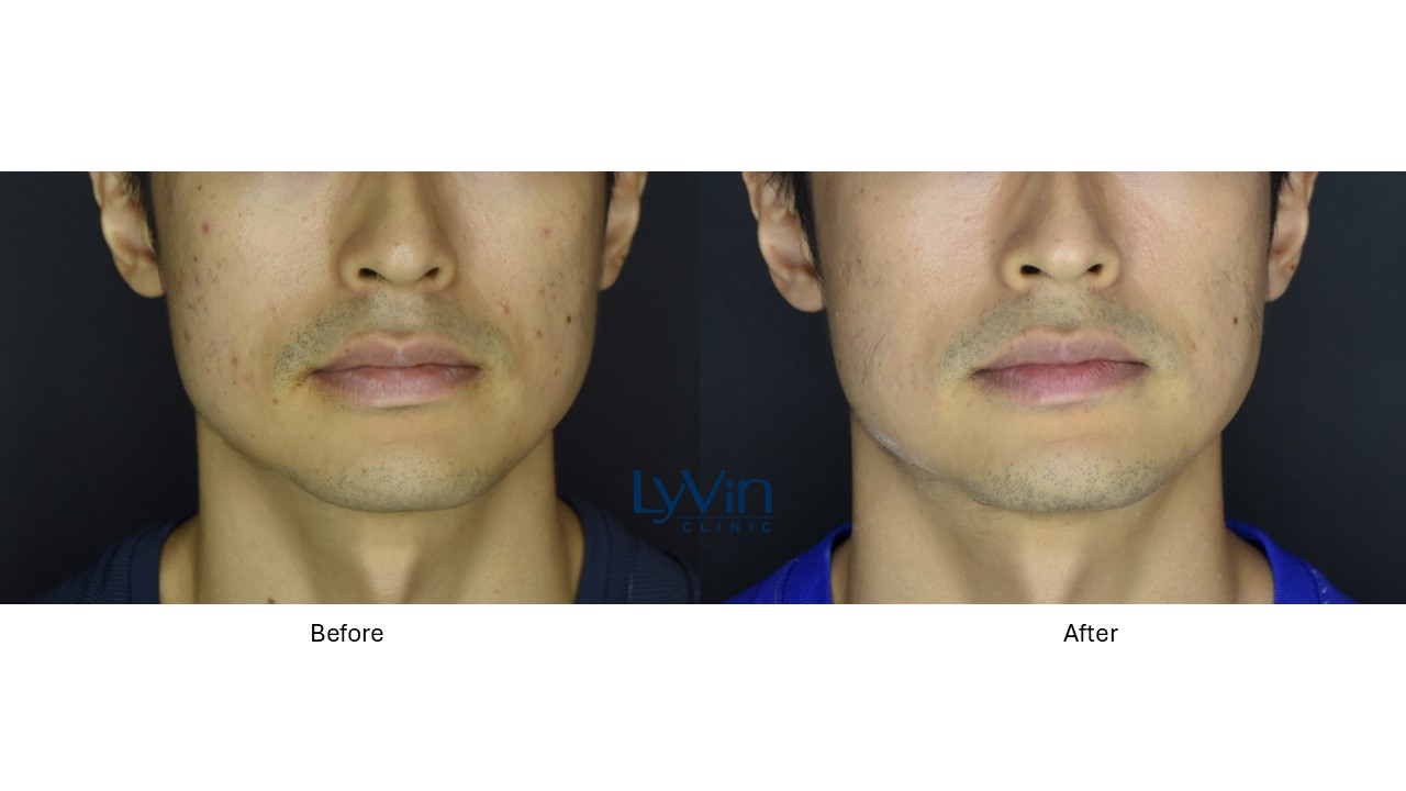 PicoSure Laser treatment before and after photo for skin improvement